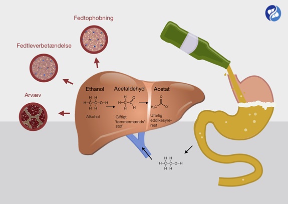 Illustration af hvorfor alkohol skader leveren