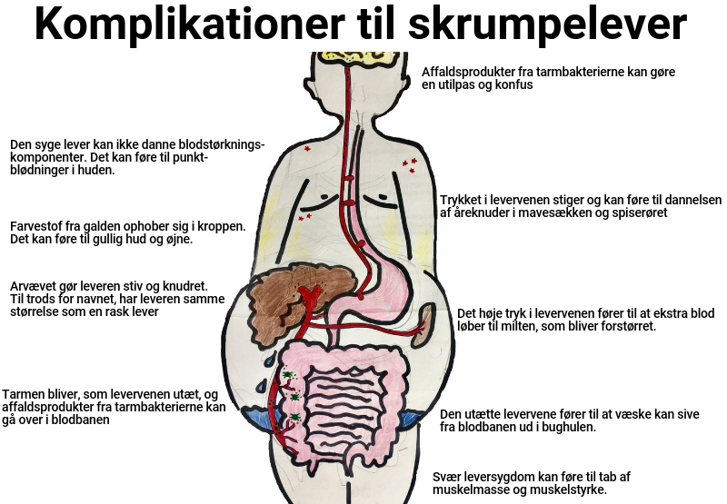Mulige komplikationer til skrumpelever