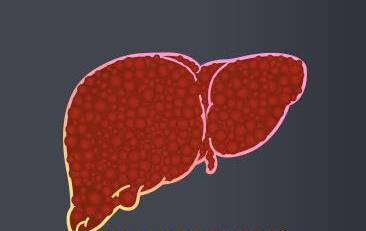 Graphic illustation Liver Cirrhosis