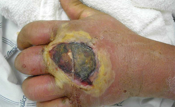 Et sår på en hånd inficeret med MRSA.