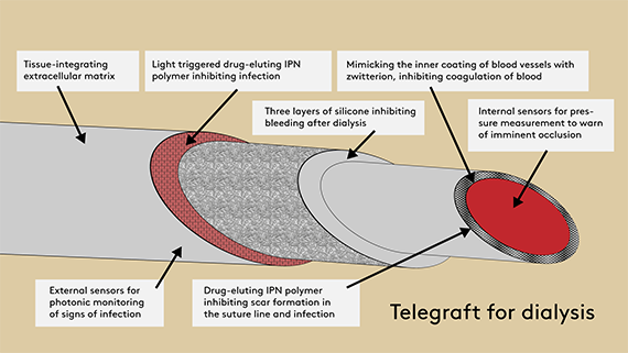 Illustration af telegraft for dialysis