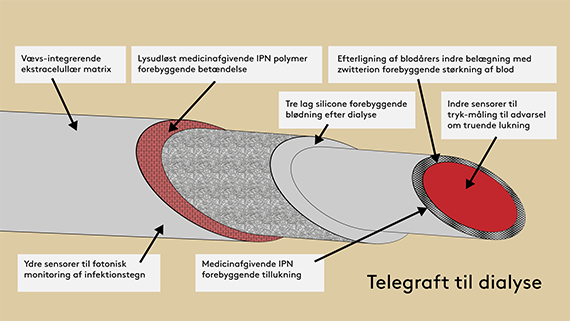 Illustration af telegraft til dialyse