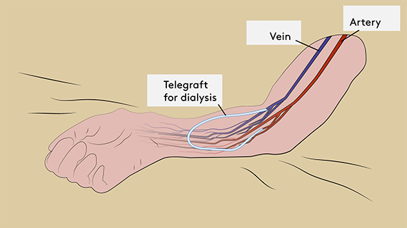 Illustration of artificial blood vessel