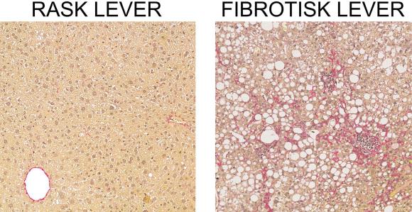 Forskellen på rask og fibrotisk lever, set under et mikroskop.