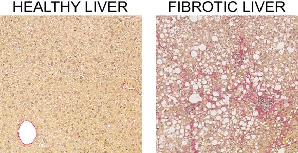 healthy and fibrotic liver under the microscope