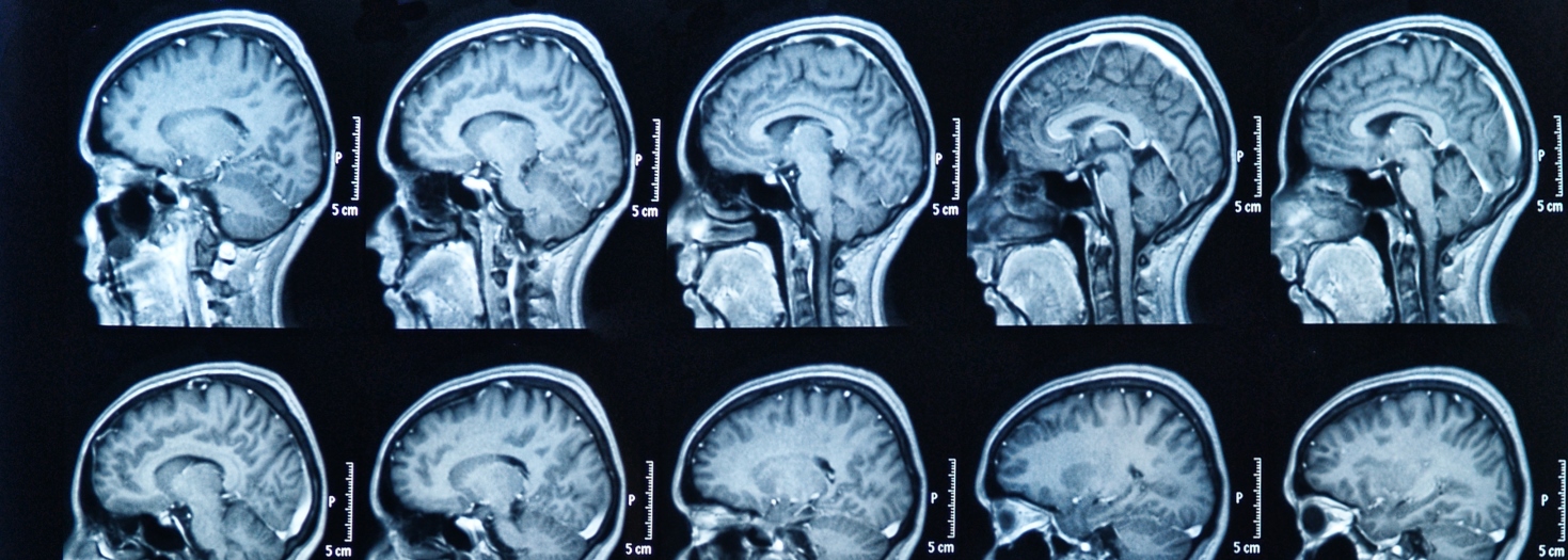 Flere MRI-billeder af en menneskelig hjerne i sideprofil arrangeret i et gitter på mørk baggrund med måleskalaer markeret "5 cm".