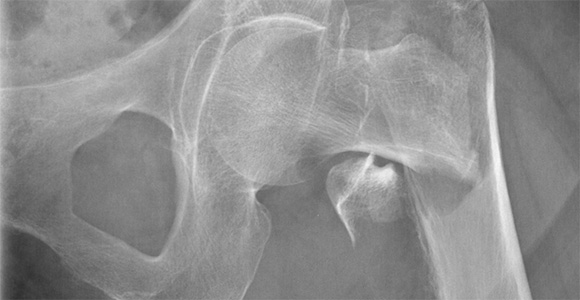 Røngten af hoftebrud