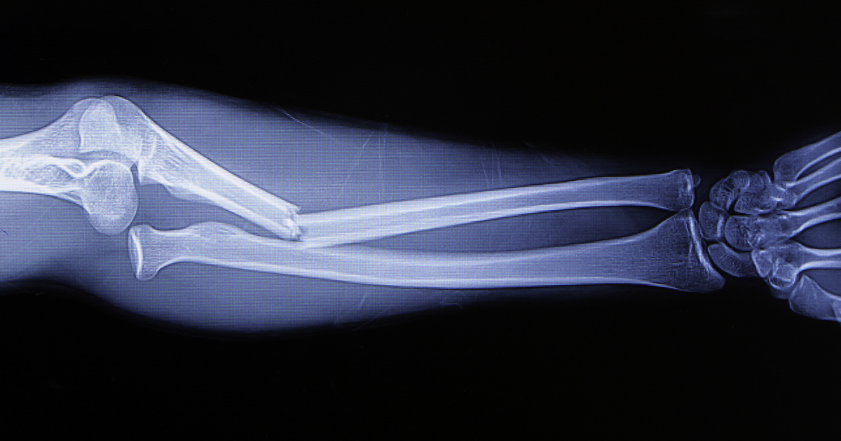 Fractures are more costly in people with type 1 diabetes