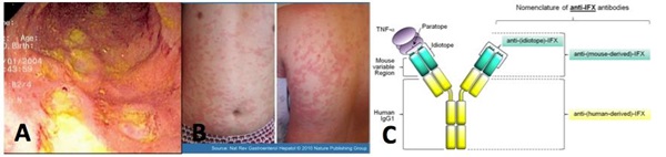 Fig. 2 Inflammatoriske mave-tarm-sygdomme og udvikling af anti-drug antistoffer. A) Endoskopi billede fra en patient med Crohn’s colitis. B) Erytematøst urticaria (nældefeber) efter behandling med Infliximab. C) Struktur af det terapeutiske antistof Infliximab. Vi har fokus på patienternes egen udvikling af immunresponser mod det indgivne terapeutiske antistof (Inflizimab); med fokus på antistoffer, der neutraliserer virkningen, i form af anti-(idiotope-IFX) og anti-(mouse-derived-IFX) antistoffer (panel A and B stammer fra medicine.medscape.com og Nature publishing group).