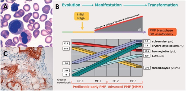 Fig. 3 Primær myelofibrose (PMF). A) Blodudstrygning fra en patient med primær myelofibrose i den fibrotiske fase (MF 2-3). Billedet illustrerer unormal tilstedeværelse af dacrocyter (dråbe-formede røde blodlegemer), kerneholdige røde blodlegemer og umodne granulocytter (leukoerythroblastosis). B) Sygdomsprocesser i primær myelofibrose (PMF), hæmatologiske data (median værdier) og graduering af PMF (MF 0-3). C) PINP lokalisering / syntese i knoglemarven fra PMF patienter, med MF grad 3 (panel A og B stammer fra WHO PubCan database for humane kræftformer, www.pubcan.org).