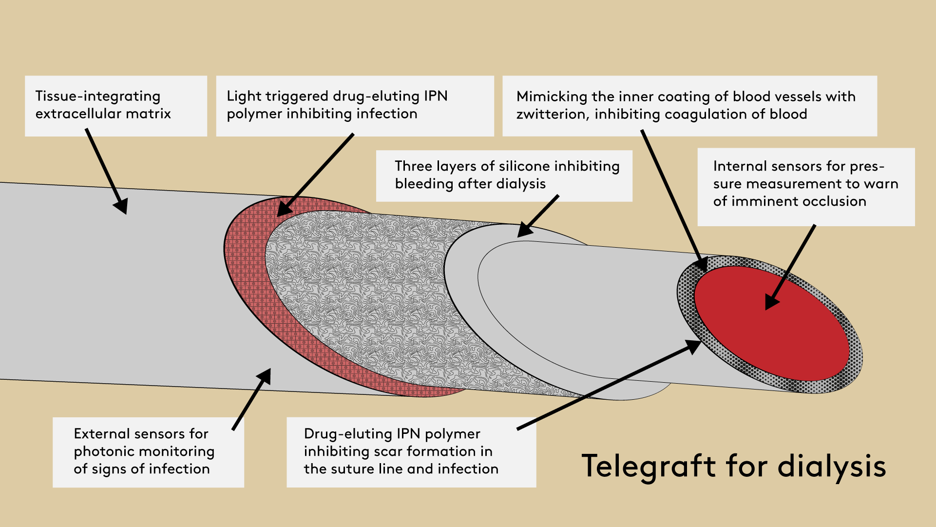 Graphic of the TeleGraft graft
