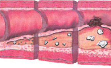 Cardivascular diseases
