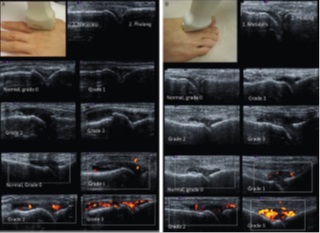 Figure 2: From the Atlas showing the position of the scanner at the joint and how points to the different grades of joint effusion and power Doppler signal are obtained.