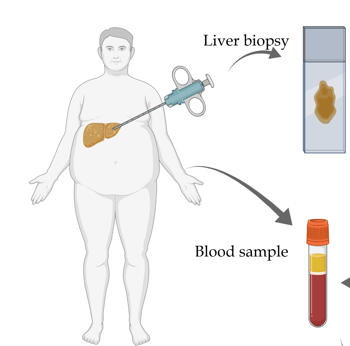 Illustration of liver biopsy and blood sample