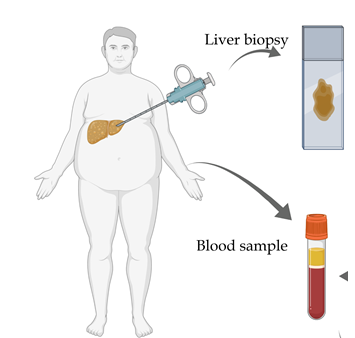 Illustration of liver biopsy and blood sample